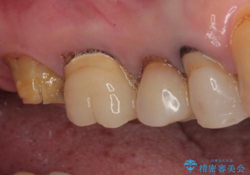 食事が取れないほどの激痛 奥歯のインプラント治療の治療前