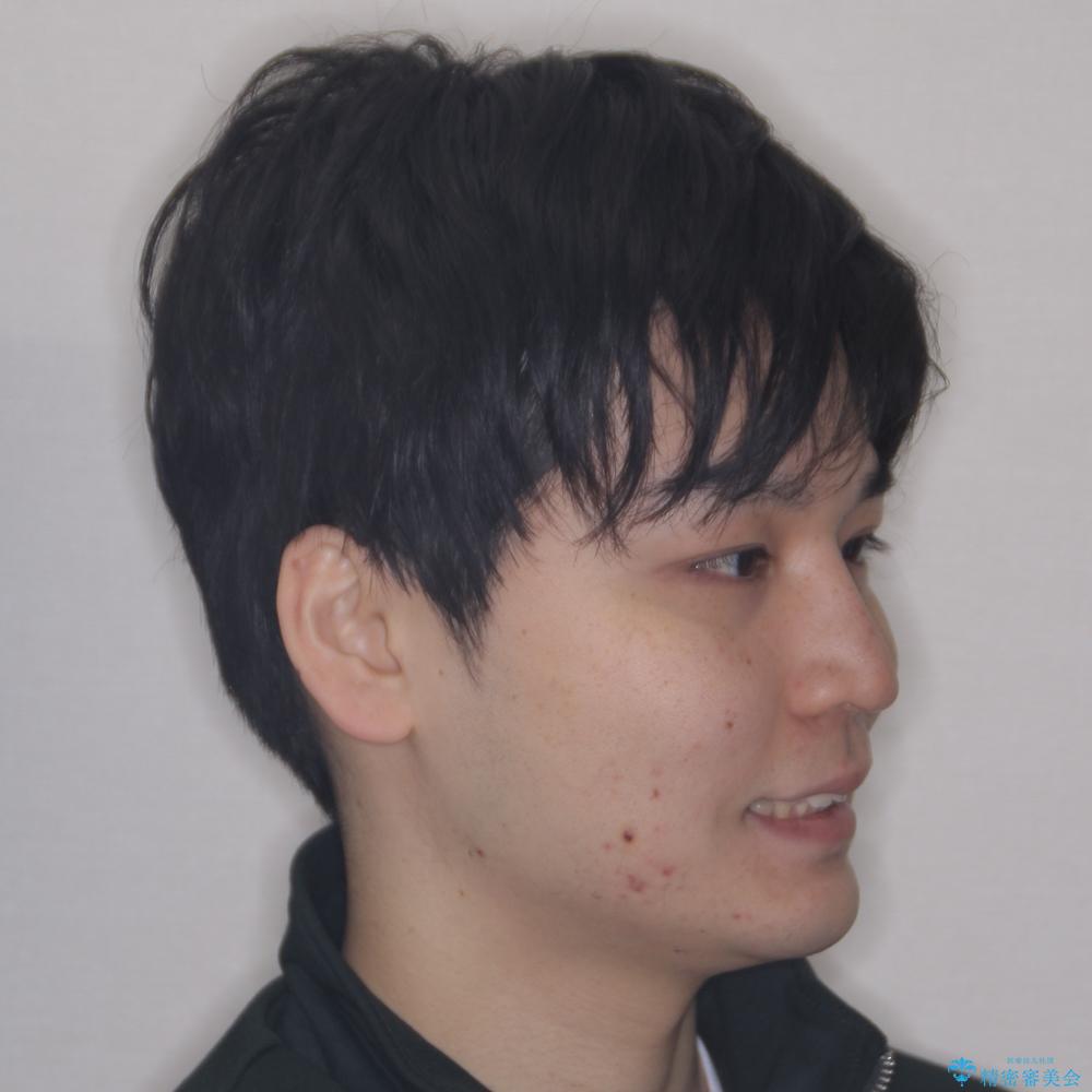 【モニター】八重歯とデコボコを治したい 補助装置を併用したワイヤー矯正の治療前(顔貌)