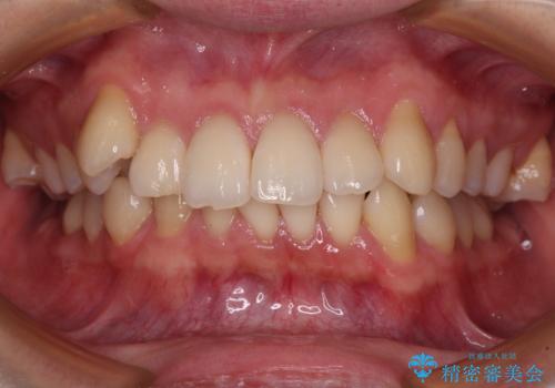 【モニター】八重歯とデコボコを治したい 補助装置を併用したワイヤー矯正の治療前