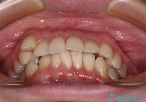 【モニター】八重歯とデコボコを治したい 補助装置を併用したワイヤー矯正の治療前