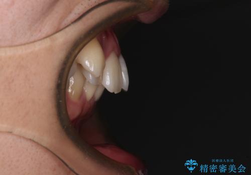 【モニター】八重歯とデコボコを治したい 補助装置を併用したワイヤー矯正の治療前