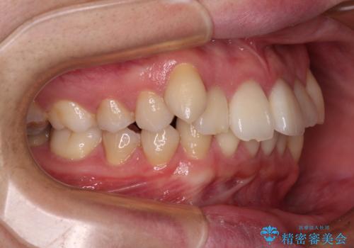 【モニター】八重歯とデコボコを治したい 補助装置を併用したワイヤー矯正の治療前