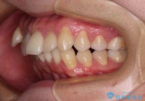 【モニター】八重歯とデコボコを治したい 補助装置を併用したワイヤー矯正の治療前