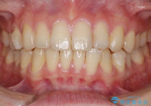 【非抜歯】インビザラインの短期治療の治療中