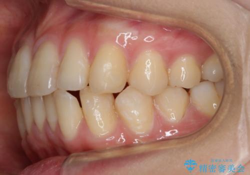 【非抜歯】インビザラインの短期治療の治療中