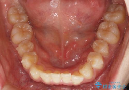 【非抜歯】インビザラインの短期治療の治療中