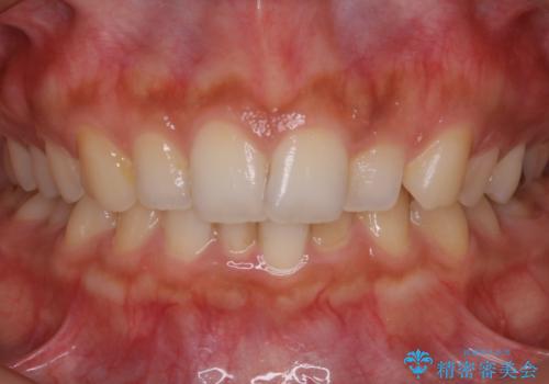 【非抜歯】ゴムかけで噛み合わせを改善!インビザライン治療の治療前