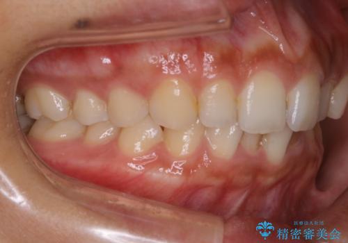 【非抜歯】ゴムかけで噛み合わせを改善!インビザライン治療の治療前