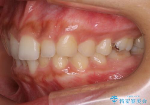 【非抜歯】ゴムかけで噛み合わせを改善!インビザライン治療の治療前