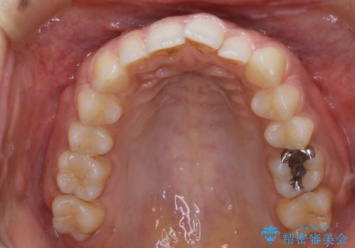 【非抜歯】ゴムかけで噛み合わせを改善!インビザライン治療の治療前