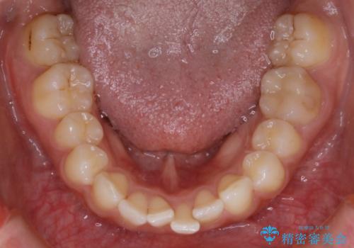 【非抜歯】ゴムかけで噛み合わせを改善!インビザライン治療の治療前