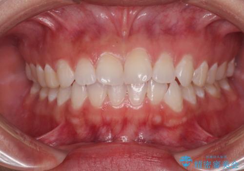 【モニター】マウスピース矯正が煩わしい ワイヤー装置での非抜歯矯正の症例 治療前