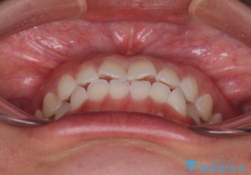 【モニター】マウスピース矯正が煩わしい ワイヤー装置での非抜歯矯正の治療前