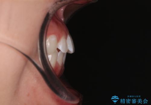 【モニター】マウスピース矯正が煩わしい ワイヤー装置での非抜歯矯正の治療前