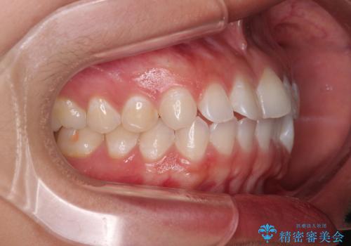 【モニター】マウスピース矯正が煩わしい ワイヤー装置での非抜歯矯正の治療前