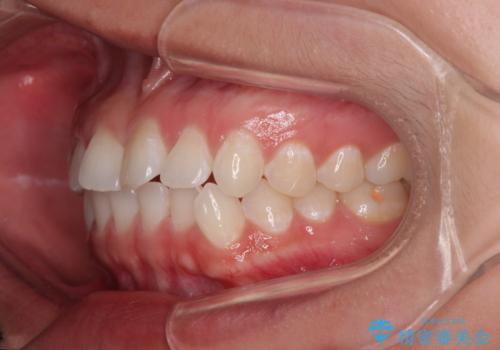 【モニター】マウスピース矯正が煩わしい ワイヤー装置での非抜歯矯正の治療前