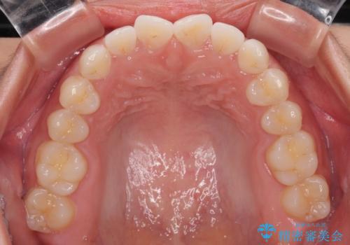 【モニター】マウスピース矯正が煩わしい ワイヤー装置での非抜歯矯正の治療前