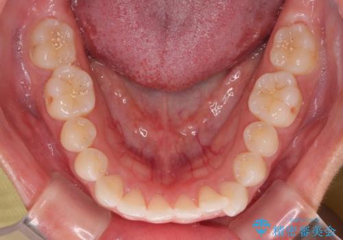 【モニター】マウスピース矯正が煩わしい ワイヤー装置での非抜歯矯正の治療前