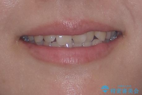 前歯のねじれ・ガタガタを10か月で改善!20代女性の矯正治療|クリアブラケットでむし歯になりにくい歯並びへ改善の治療前(顔貌)