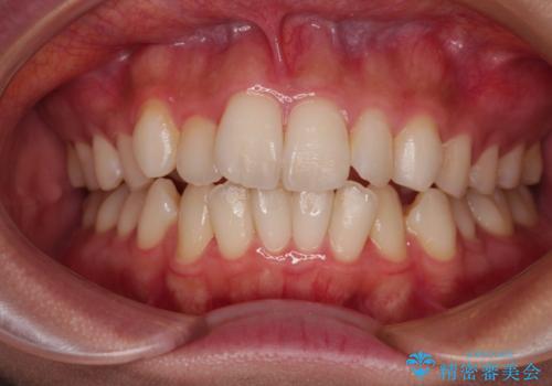 横顔の印象を改善したい ワイヤー装置での抜歯矯正の症例 治療前