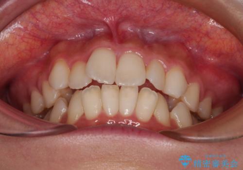 横顔の印象を改善したい ワイヤー装置での抜歯矯正の治療前