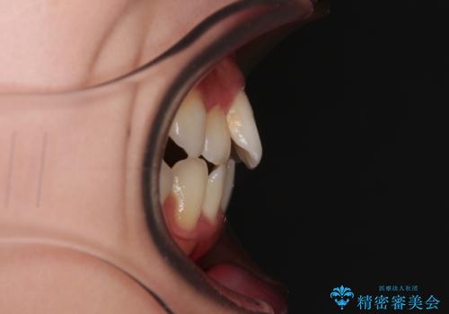 横顔の印象を改善したい ワイヤー装置での抜歯矯正の治療前