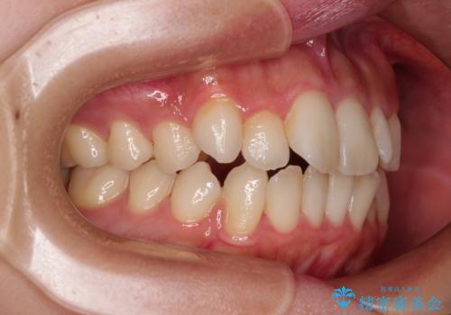 横顔の印象を改善したい ワイヤー装置での抜歯矯正の治療前