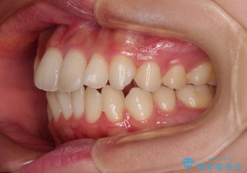 横顔の印象を改善したい ワイヤー装置での抜歯矯正の治療前