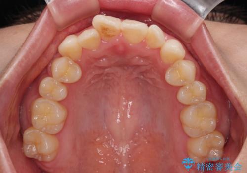 横顔の印象を改善したい ワイヤー装置での抜歯矯正の治療前