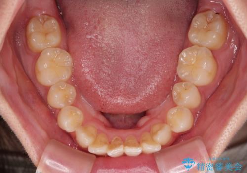 横顔の印象を改善したい ワイヤー装置での抜歯矯正の治療前