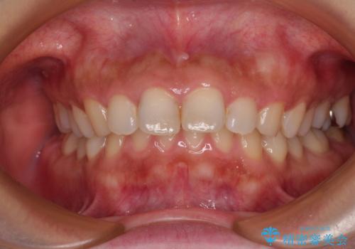 出っ歯を治したい ワイヤー装置での抜歯矯正の症例 治療前