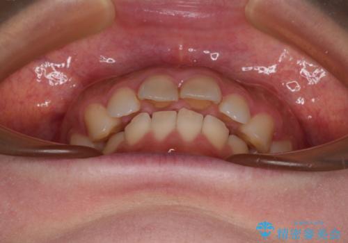 出っ歯を治したい ワイヤー装置での抜歯矯正の治療前