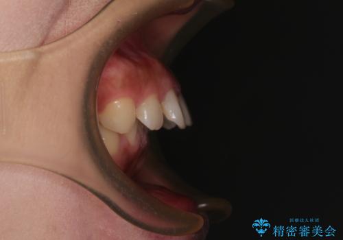 出っ歯を治したい ワイヤー装置での抜歯矯正の治療前