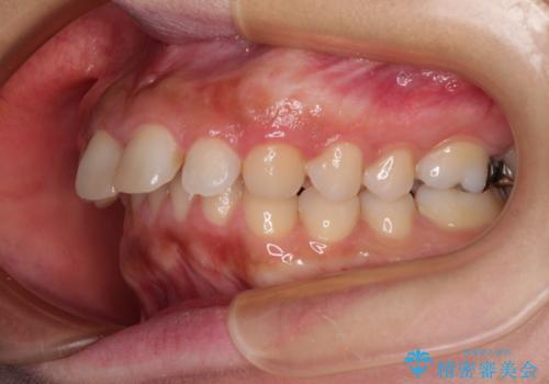 出っ歯を治したい ワイヤー装置での抜歯矯正の治療前