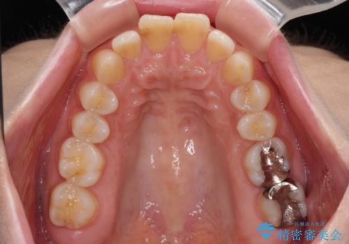 出っ歯を治したい ワイヤー装置での抜歯矯正の治療前