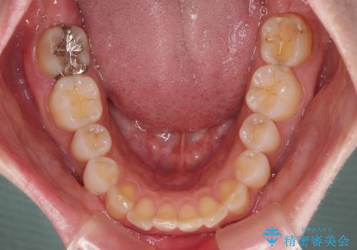 出っ歯を治したい ワイヤー装置での抜歯矯正の治療前