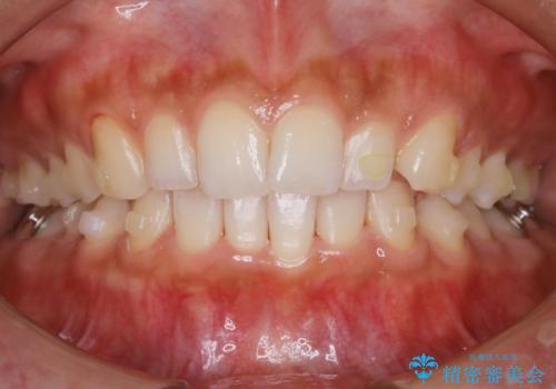 【非抜歯】ゴムかけで噛み合わせを改善!インビザライン治療の治療中