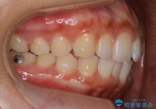 【非抜歯】ゴムかけで噛み合わせを改善!インビザライン治療の治療中