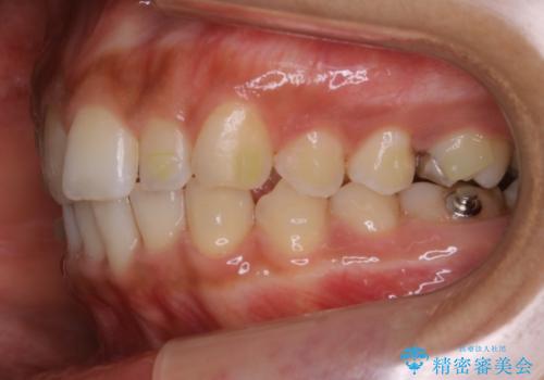 【非抜歯】ゴムかけで噛み合わせを改善!インビザライン治療の治療中