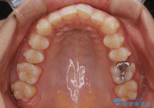 【非抜歯】ゴムかけで噛み合わせを改善!インビザライン治療の治療中