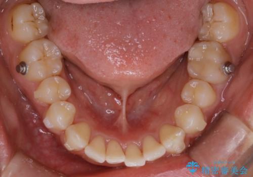 【非抜歯】ゴムかけで噛み合わせを改善!インビザライン治療の治療中