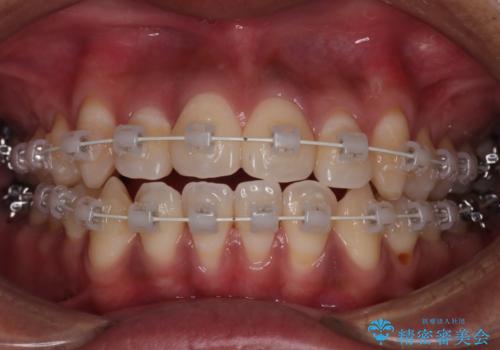【審美装置】開口(オープンバイト)を改善の治療中