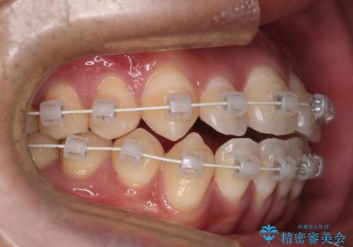 【審美装置】開口(オープンバイト)を改善の治療中