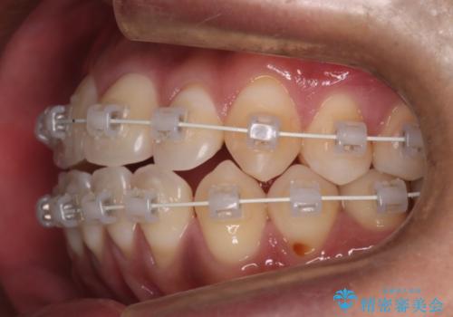 【審美装置】開口(オープンバイト)を改善の治療中