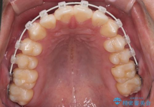 【審美装置】開口(オープンバイト)を改善の治療中