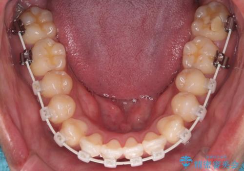 【審美装置】開口(オープンバイト)を改善の治療中