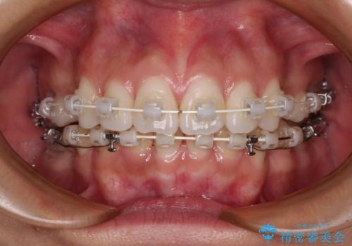 膨らんだ口元を改善する抜歯矯正 インプラント治療も同時に行う総合歯科治療の治療中