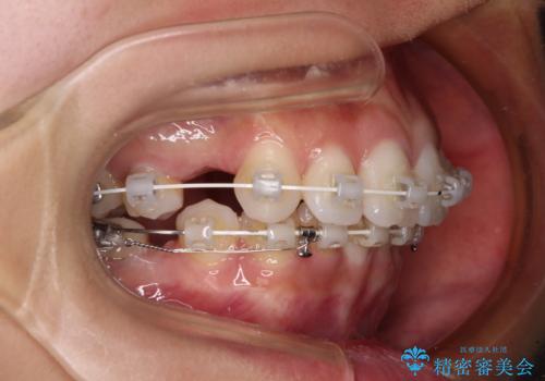 膨らんだ口元を改善する抜歯矯正 インプラント治療も同時に行う総合歯科治療の治療中