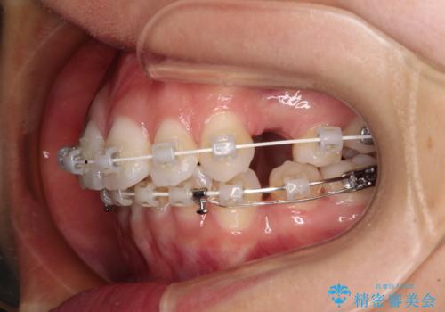 膨らんだ口元を改善する抜歯矯正 インプラント治療も同時に行う総合歯科治療の治療中