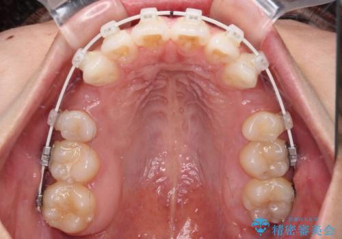 膨らんだ口元を改善する抜歯矯正 インプラント治療も同時に行う総合歯科治療の治療中